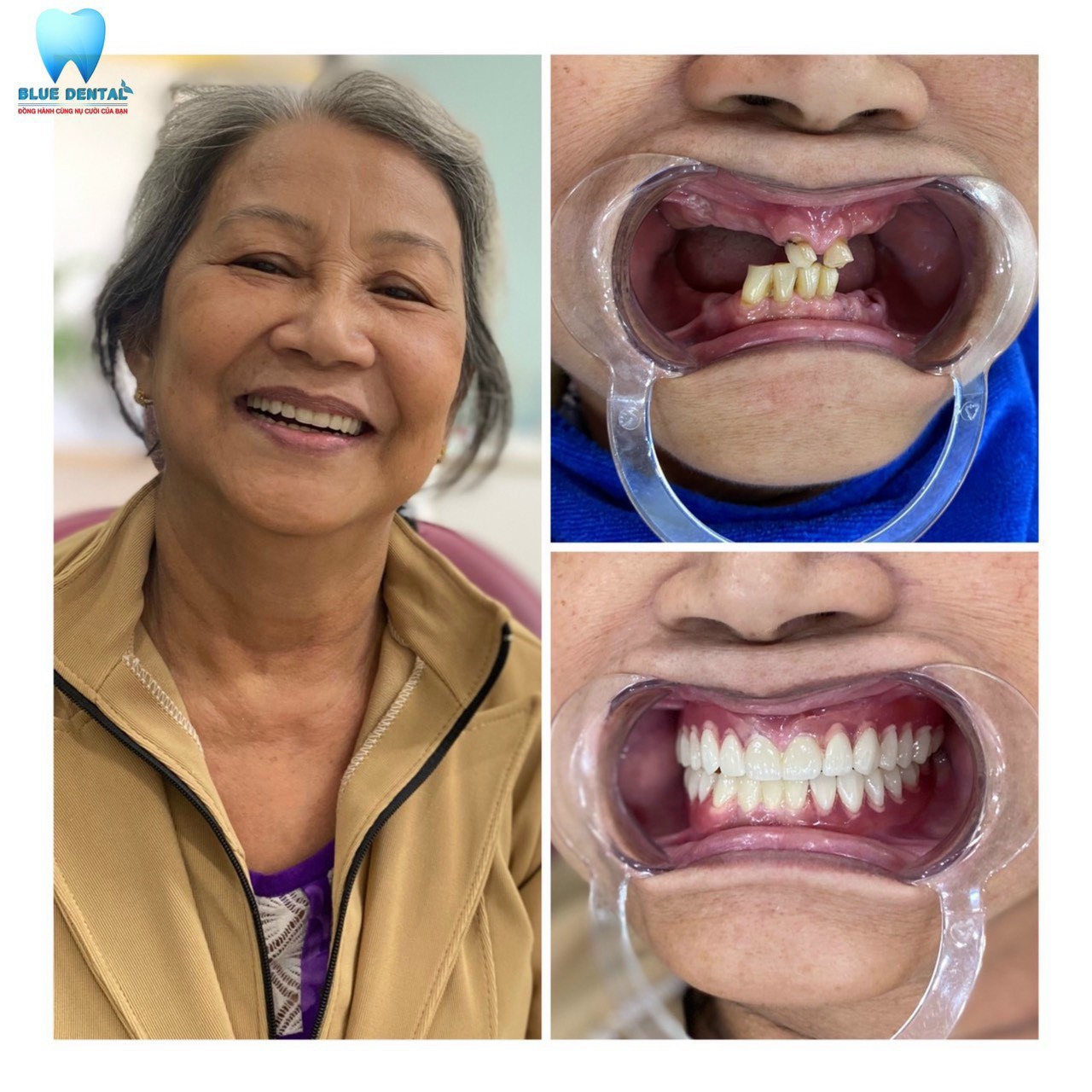 Địa chỉ làm răng uy tín tại quận Tân Bình, nha khoa Blue Dental