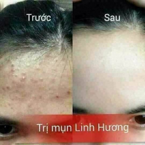 Trị mụn hiệu quả với kem mụn và tinh chất mụn Linh Hương.