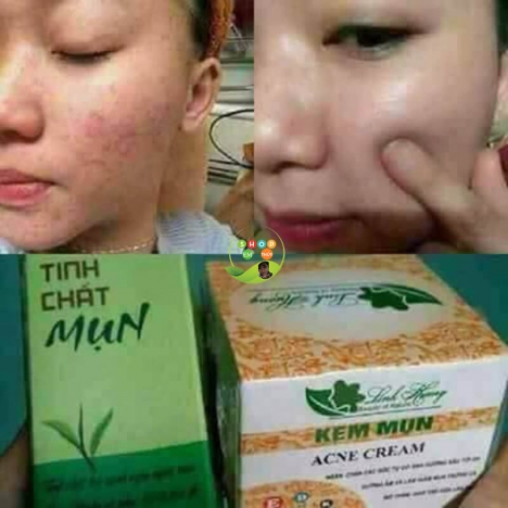 Trị mụn hiệu quả với kem mụn và tinh chất mụn Linh Hương.