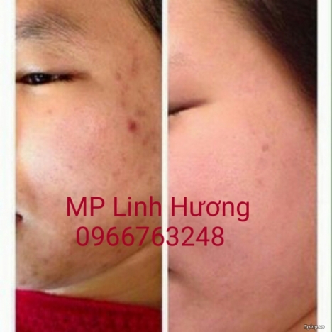 Trị mụn hiệu quả với kem mụn và tinh chất mụn Linh Hương.