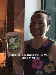 Thảo dược Đặc Trị Nám