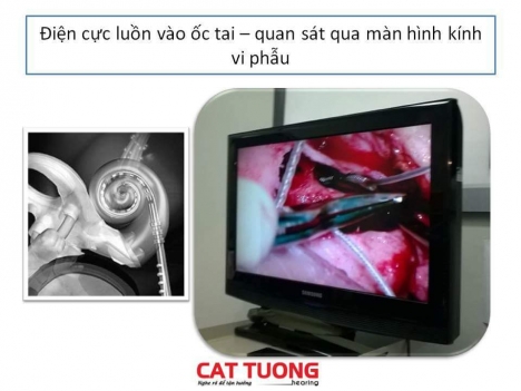 Dịch vụ đo khám và can thiệp cho trẻ điếc bẩm sinh