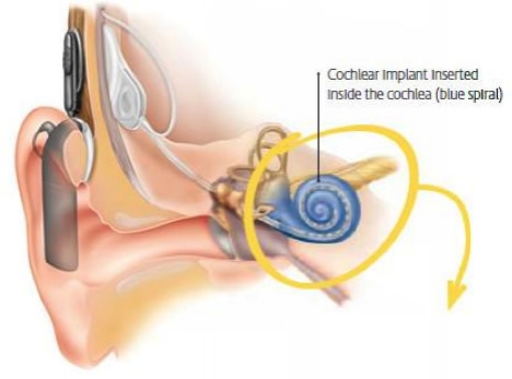 ỐC tai điện tử Cochlear Quảng Ninh