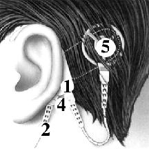 ĐIỆN CỰC ỐC TAI COCHLEAR QUẢNG NINH