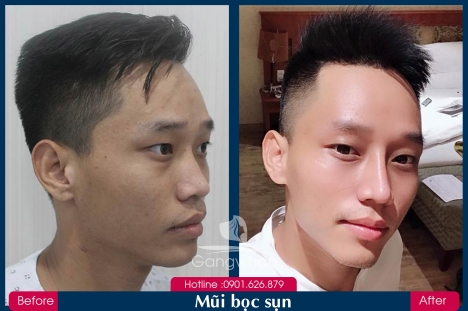 Bác sĩ Phùng Mạnh Cường chuyên nâng mũi