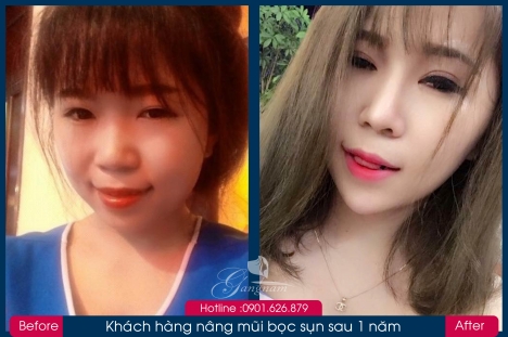 Bác sĩ Phùng Mạnh Cường chuyên nâng mũi