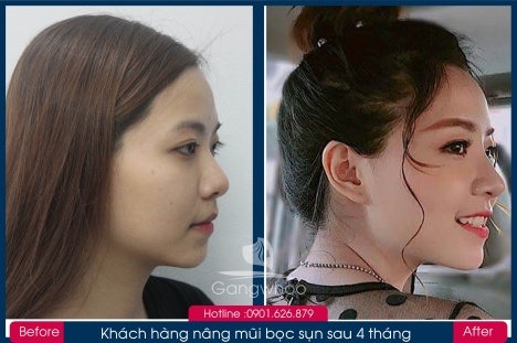 Bác sĩ Phùng Mạnh Cường chuyên nâng mũi