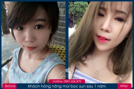 Bác sĩ Phùng Mạnh Cường chuyên nâng mũi
