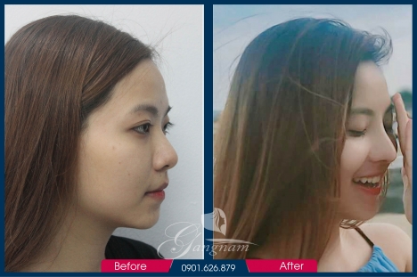 Bác sĩ Phùng Mạnh Cường chuyên nâng mũi