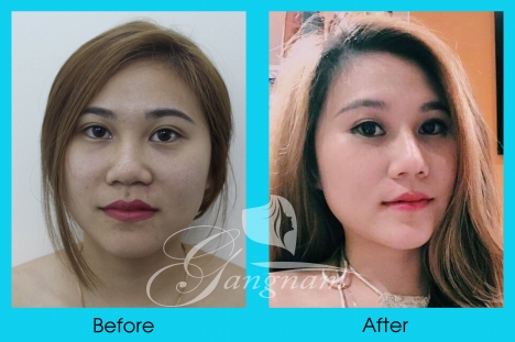 Bác sĩ Phùng Mạnh Cường chuyên nâng mũi