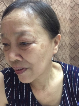 Máy trợ thính trong tai nhỏ gọn, thẩm mỹ