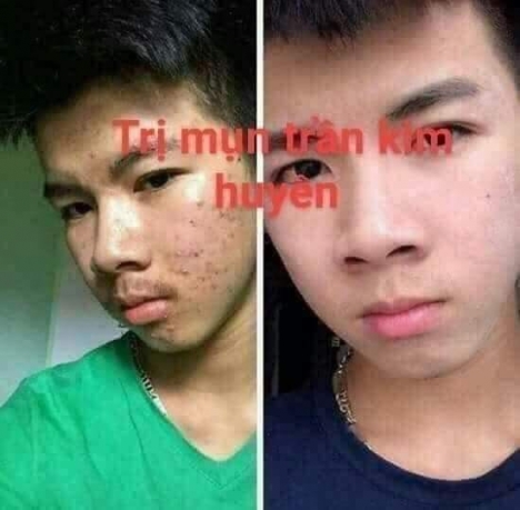 Thuốc đặc trị Mụn từ thảo mộc thiên nhiên