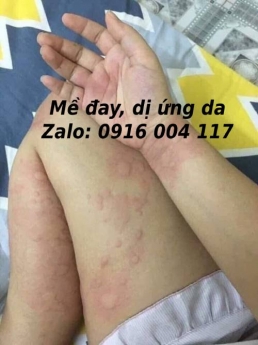 Trị dứt điểm mề đay sau sinh, dị ứng thời tiết các loại