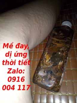 Trị dứt điểm mề đay sau sinh, dị ứng thời tiết các loại
