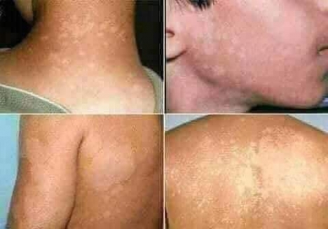 Trị hắc lào, lang ben vẩy nến các loại giá rẻ