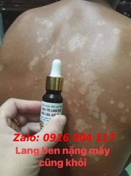 Trị hắc lào, lang ben vẩy nến các loại giá rẻ