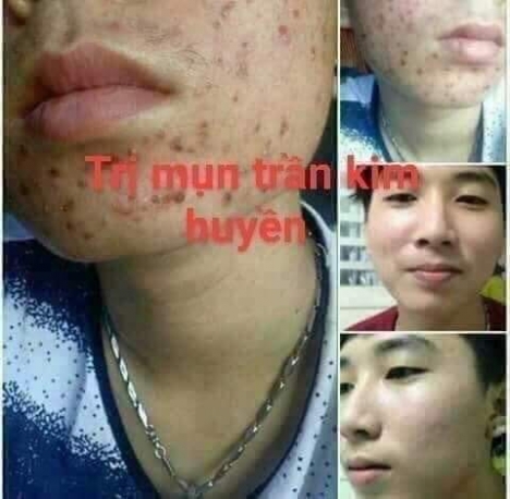 Thuốc đặc trị Mụn từ thảo mộc thiên nhiên