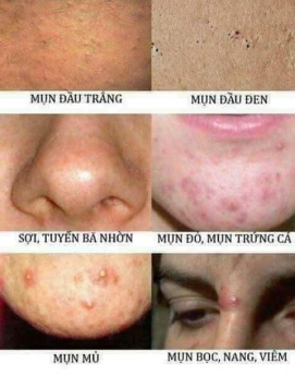 Thuốc đặc trị Mụn từ thảo mộc thiên nhiên