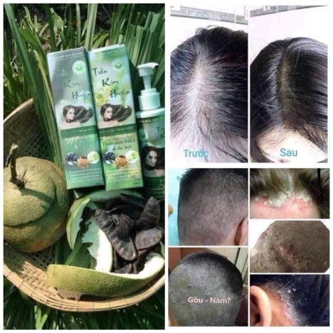 Trị nấm da dầu, viêm da đầu, giảm rụng tóc giá rẻ