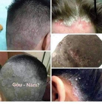 Trị nấm da dầu, viêm da đầu, giảm rụng tóc giá rẻ