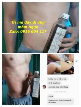 Trị dứt điểm mề đay sau sinh, dị ứng thời tiết các loại