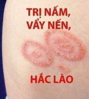 Trị hắc lào, lang ben vẩy nến các loại giá rẻ