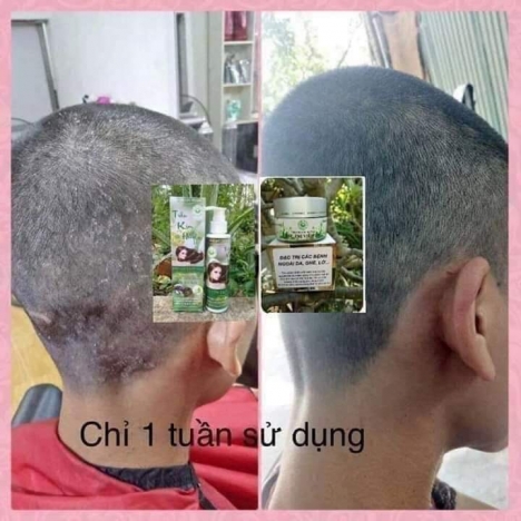 Trị nấm da dầu, viêm da đầu, giảm rụng tóc giá rẻ
