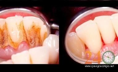 Lấy Vôi Răng, Đánh Bóng Răng Giảm Giá 50%