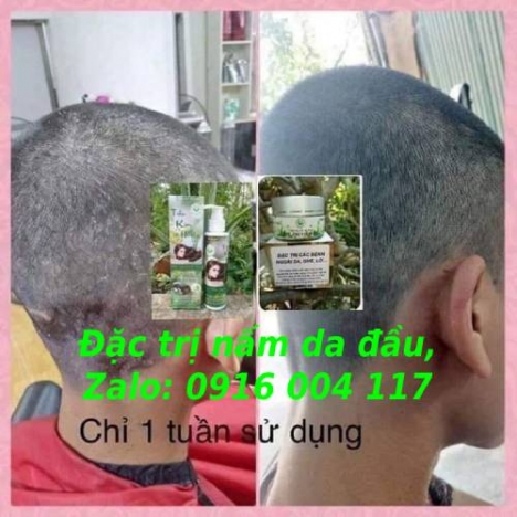 Trị bệnh viêm da đầu, nấm da đầu Lhe 0916004117