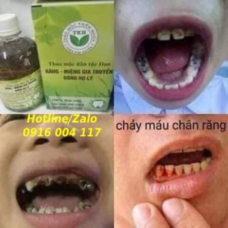 Đặc trị răng miệng,  hôi miệng sâu răng Lhe 0916004117