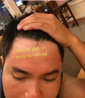 Trị bệnh viêm da đầu, nấm da đầu Lhe 0916004117