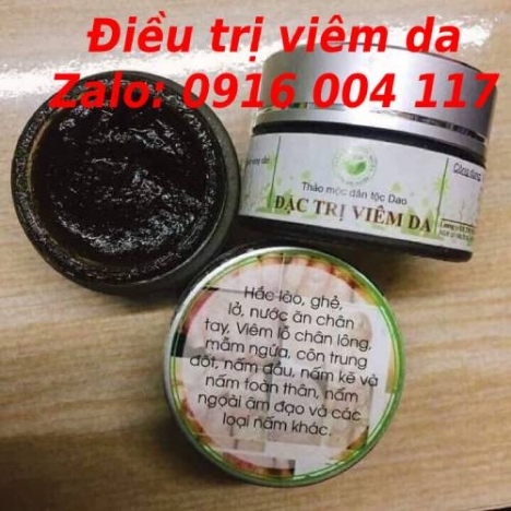 Trị bệnh viêm da đầu, nấm da đầu Lhe 0916004117