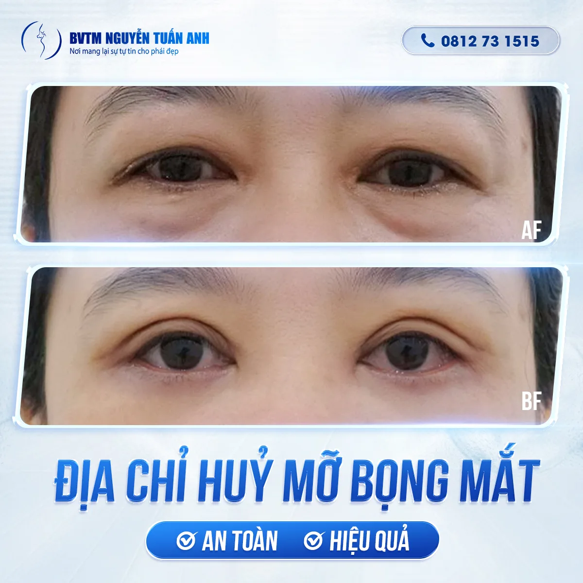 Địa Chỉ Hủy Mỡ Bọng Mắt An Toàn Và Hiệu Quả