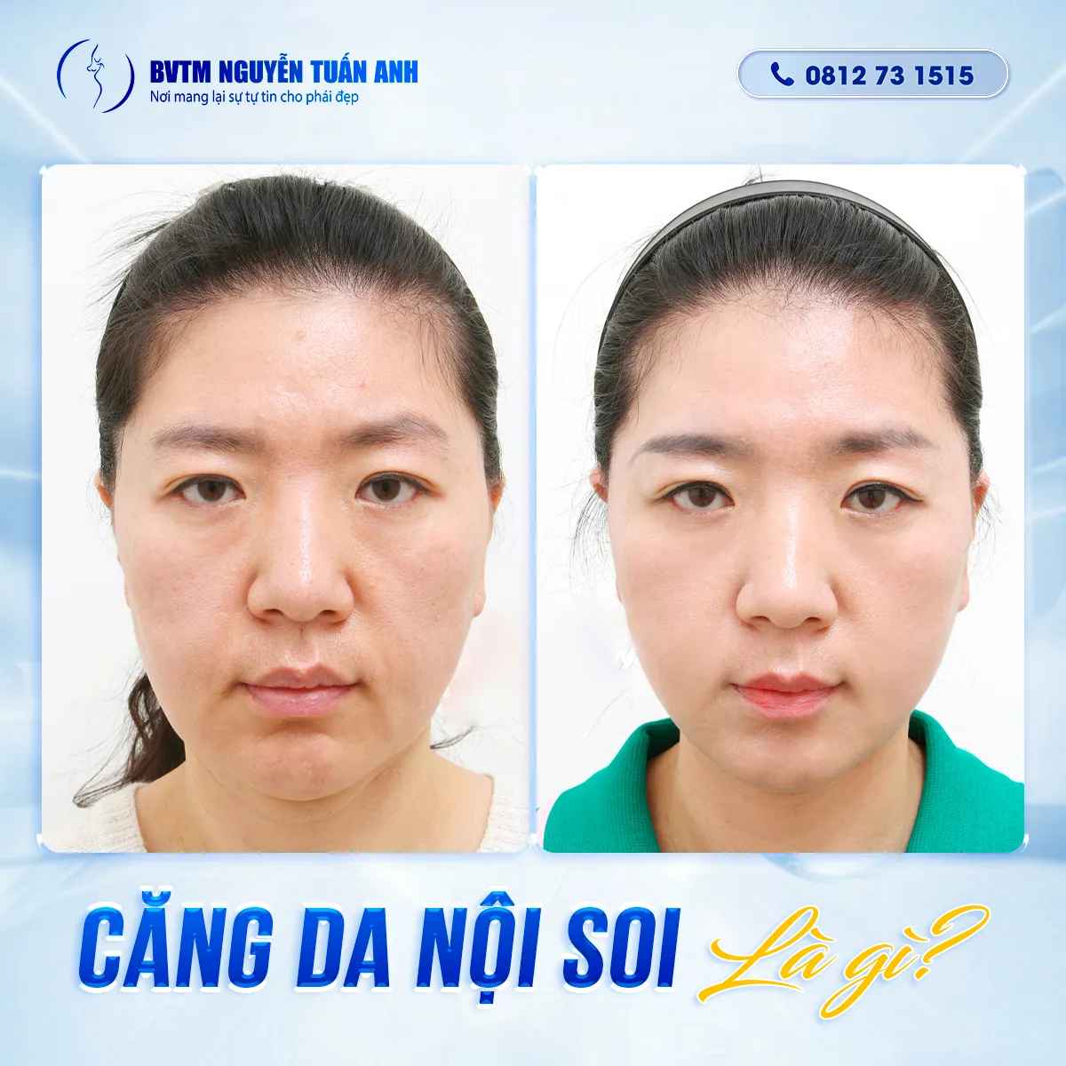 Bác Sĩ Thẩm Mỹ Nguyễn Tuấn Anh - Căng Da Nội Soi Ở Đâu An Toàn