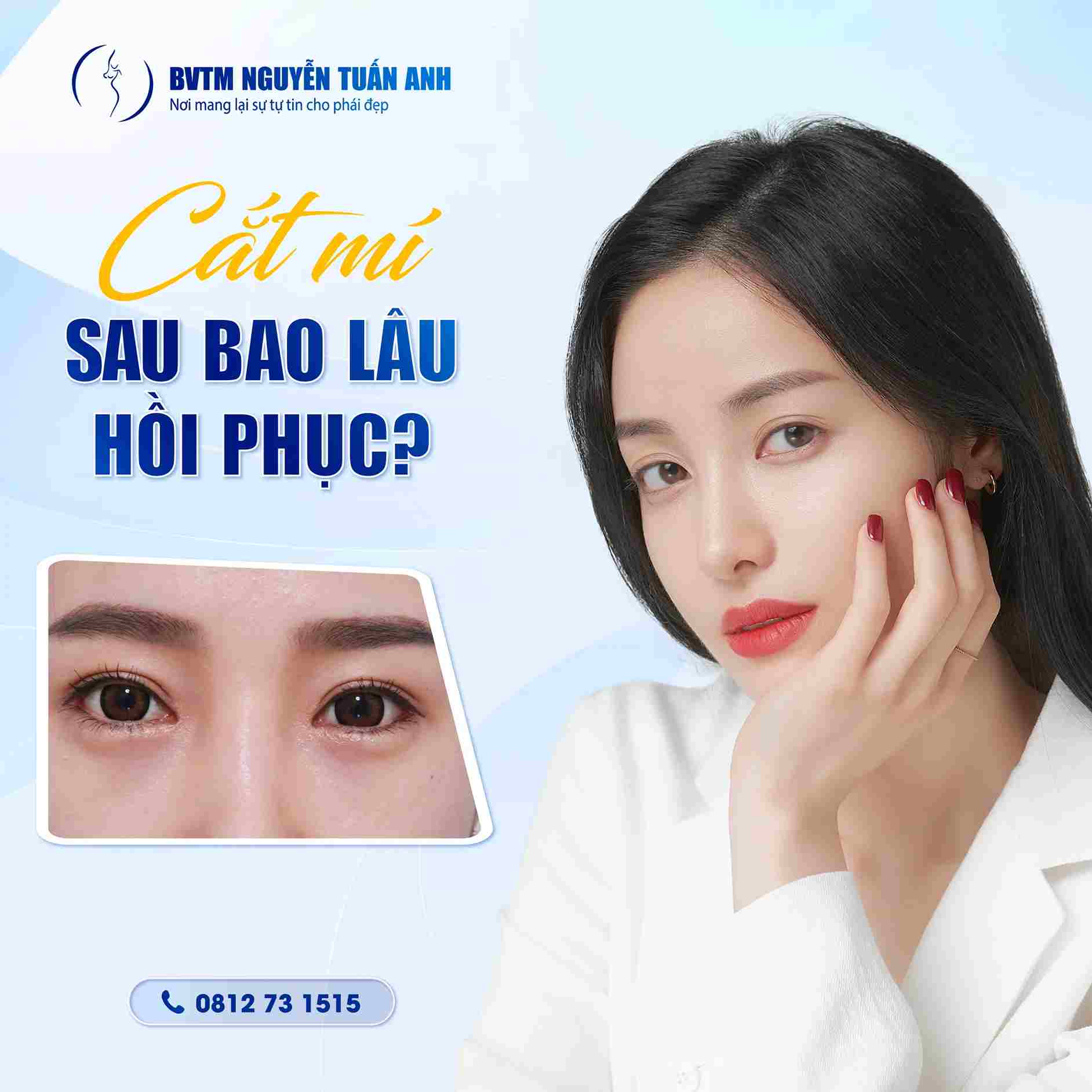 BS Thẩm Mỹ Nguyễn Tuấn Anh - Lưu Ý Sau Khi Phẫu Thuật Thẩm Mỹ Mí Mắt