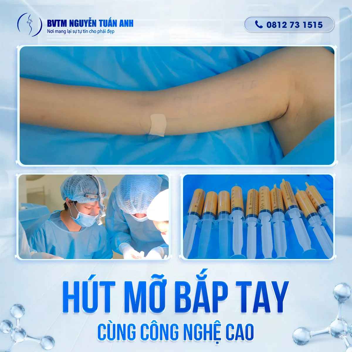 Nguyên Nhân Tích Tụ Mỡ Vùng Bắp Tay Là Gì?