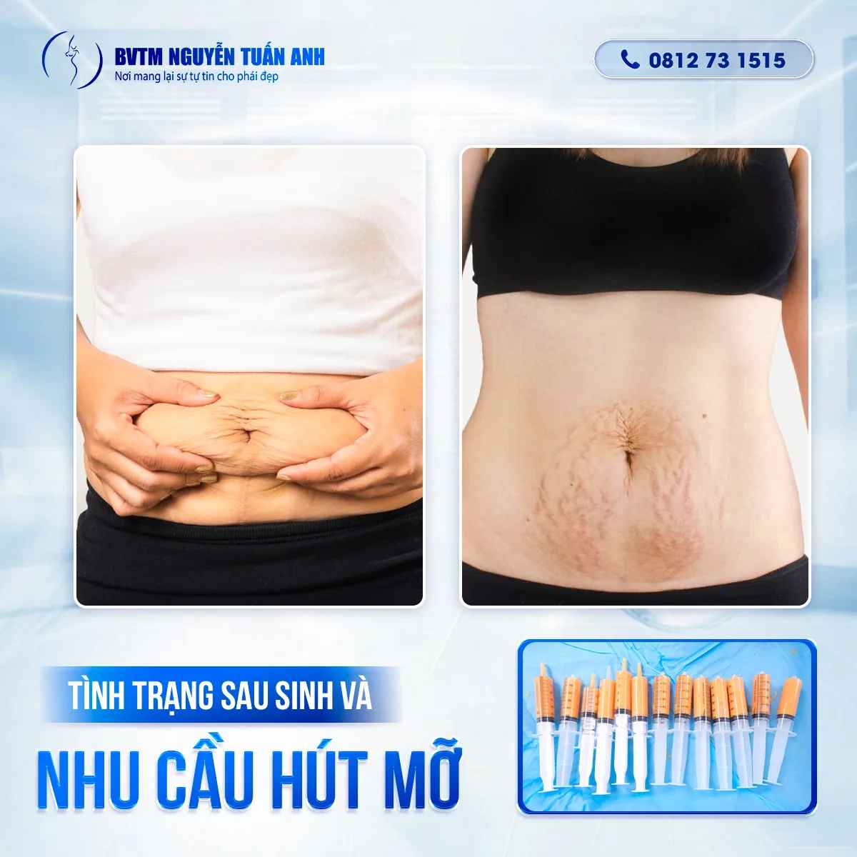 Bác Sĩ Thẩm Mỹ Nguyễn Tuấn Anh - Sau Sinh Có Nên Hút Mỡ Bụng Không?