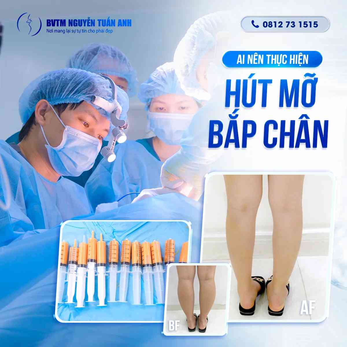 Bác Sĩ Thẩm Mỹ Nguyễn Tuấn Anh - Ai Nên Thực Hiện Hút Mỡ Bắp Chân