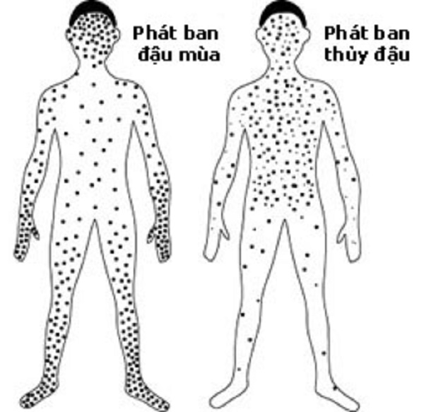 bệnh thủy đậu