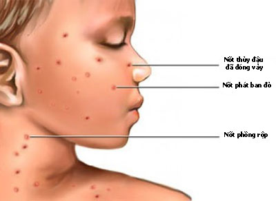 bệnh thủy đậu