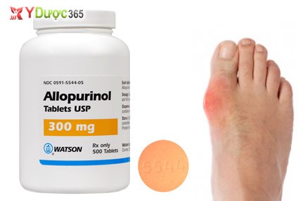 phương pháp trị bệnh Gut liên tục