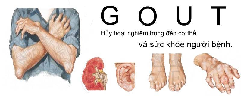 Những loại thuốc điều trị bệnh Gút hiệu quả
